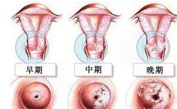 昆明女性确诊宫颈炎应该要做哪些检查？
